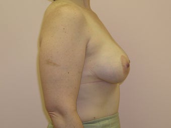 Breast Lift with Implants after 312862