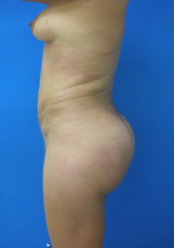 Brazilian Butt Lift 367233