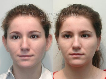 Otoplasty (Ear surgery) before 613948