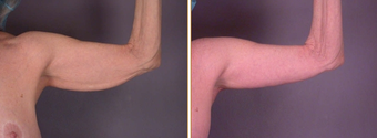 Arm Lift before 272286