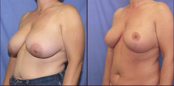 Breast Reduction after 98605