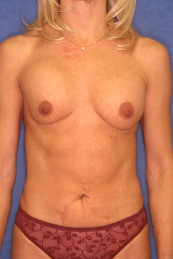 Tummy Tuck with Liposuction before 410395