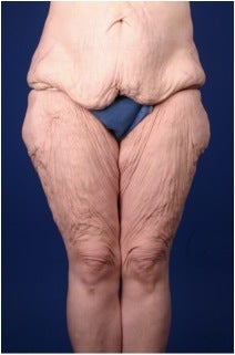 Lower Body Lift after Massive Weight Loss (Gastric Bypass) before 224112