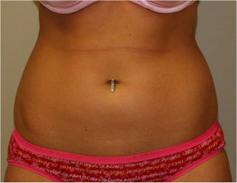 SmartLipo Love Handles Anterior View before 109442