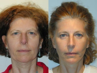 Full Facelift - Browlift, lower blepharoplasty, Lower Facelift before 137750