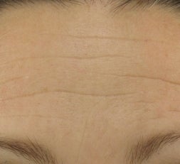 Forehead after Botox before 52830