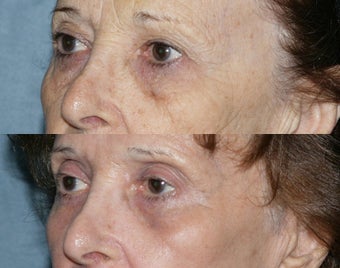 Fraxel Repair in Combination with other lasers yields best results before 149678