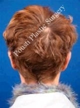 Ear Surgery (Otoplasty) after 584557