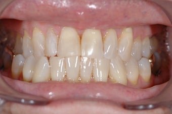 Lumineers Dental Veneers before 382135