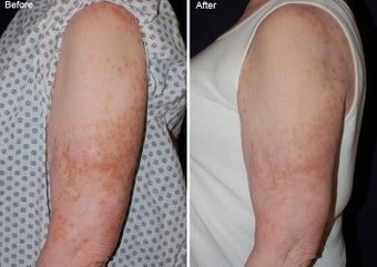 Fraxel laser resurfacing before 97764