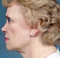 Facelift and Blepharoplasty after 209326