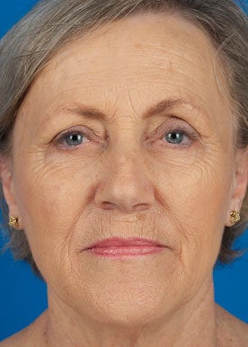 Chemical Peel before 368982