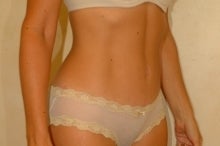 Liposuction and Tummy Tuck after 87333