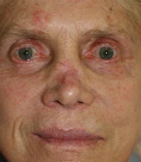 Revision rhinoplasty 380426