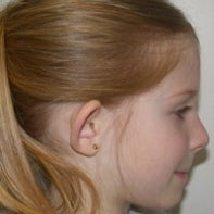 Otoplasty 443057