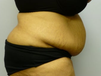 Mini Tummy Tuck and liposuction 590774