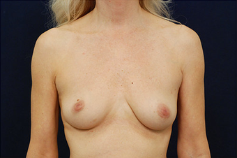 Breast Augmentation before 629087