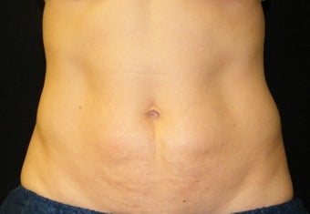 CoolSculpting after 621991