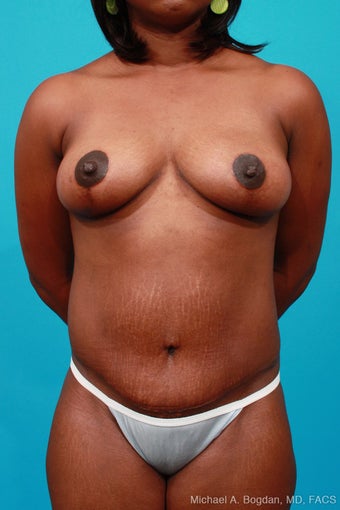 Mommy Makeover: Breast Lift & Extended Abdominoplasty after 252328