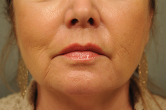 Upper lip shortening after 451906