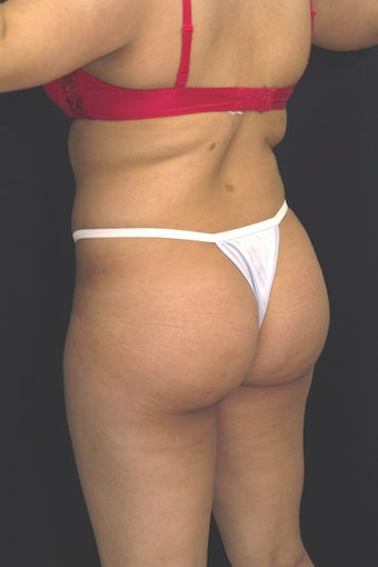 Fat injections to buttocks for Brazilian Butt Lift after 101299