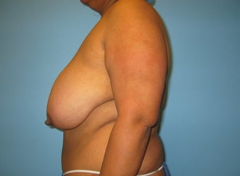breast reduction before 284100