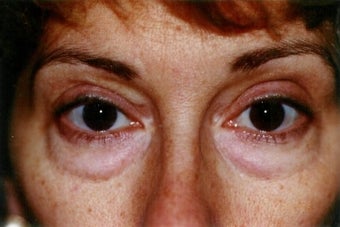 Blepharoplasty (lower eyelid surgery) before 278476