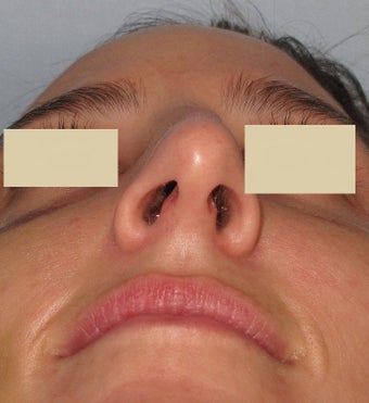 Rhinoplasty, Broken Nose before 127193