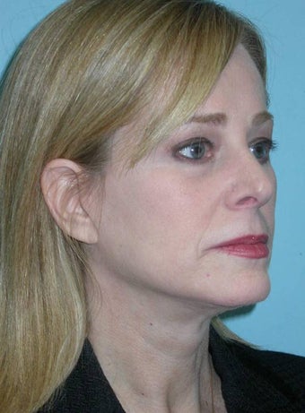 Full Facial Rejuvenation and Rhinoplasty after 182370
