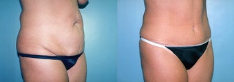 Tummy Tuck & Lipo before 350991