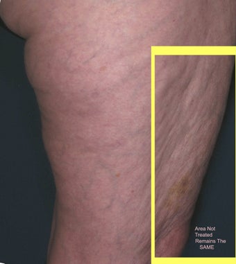 Cellulite treatment after 113276