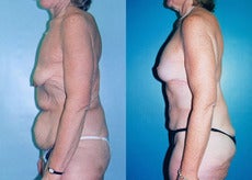 Upper Body & Back Lift After Major Weight Loss before 352827