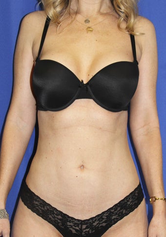 Laser-assisted Liposuction after 364499