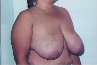 Breast Reduction before 218957