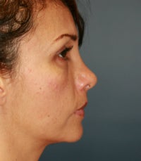 Revision tip rhinoplasty 605294