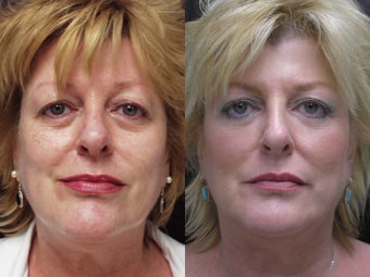 Non-surgical face lift before 591359