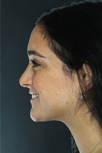 Rhinoplasty 327037