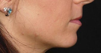 Lip Augmentation before 399251