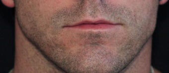 Male lip augmentation before 393232