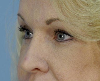 Restylane under Eyes after 135868