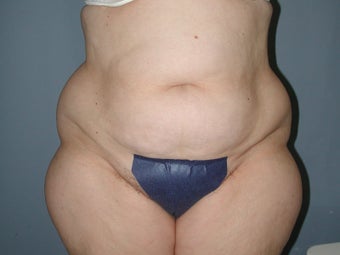 Liposuction hips, waist, upper and lower abdomen, lateral thighs before 581418