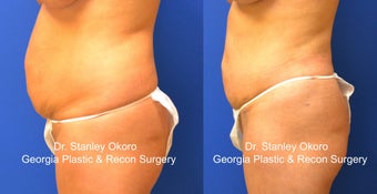 Mini Tummy Tuck after 568405