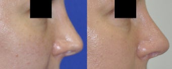 Revision Rhinoplasty before 548879