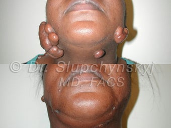 Keloid Removal after 548814