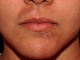 Scar Treatment 555507