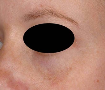 Bue veins under eyes after 136693