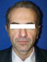 Ear Surgery (otoplasty) after 124885
