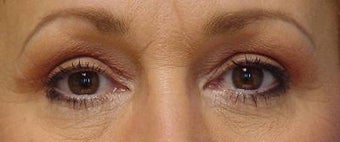 Upper Blepharoplasty after 251707