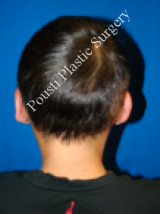 Ear Surgery (Otoplasty) after 579094
