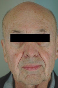 Pulsed Dye Laser Treatment for Rosacea after 104186